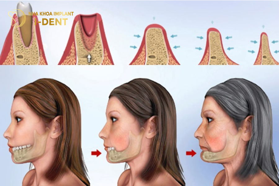 Tiêu xương hàm là tác hại nghiêm trọng và phổ biến nhất của việc mất răng lâu năm. mất răng lâu năm