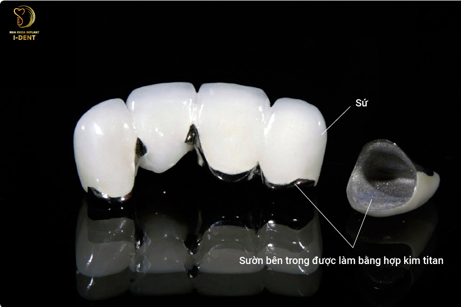 giá răng sứ titan - Răng sứ Titan giá răng sứ titan - Răng sứ Titan