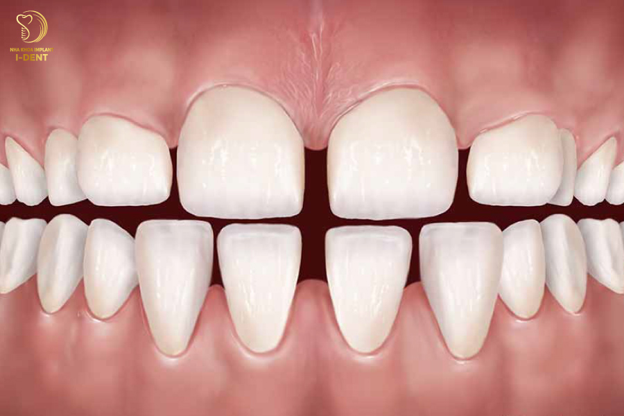 Răng cửa thưa ở mức độ nhẹ