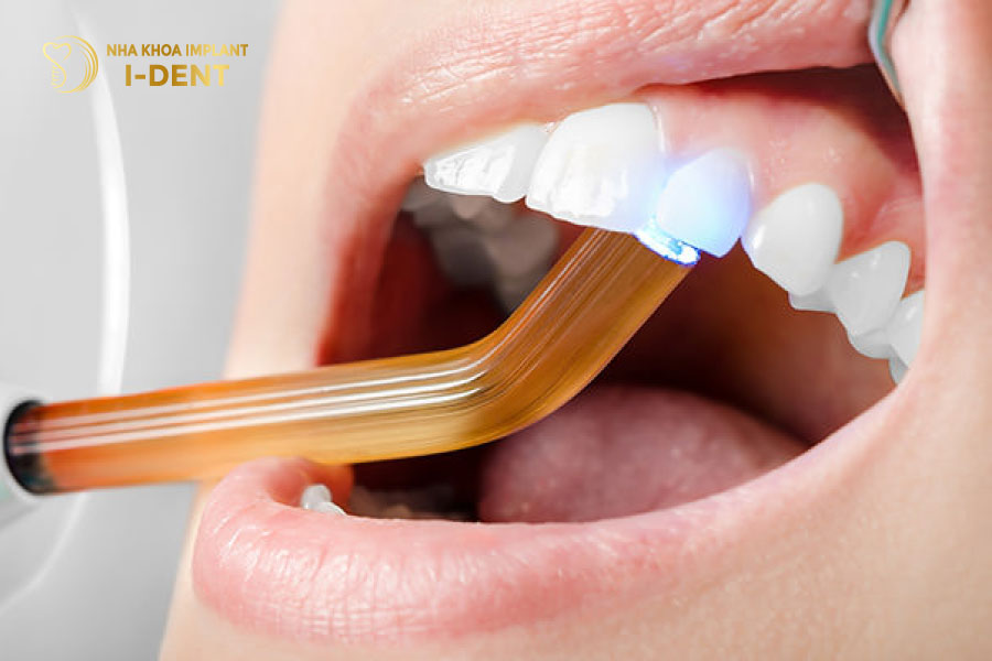Trám răng thẩm mỹ Trám răng thẩm mỹ