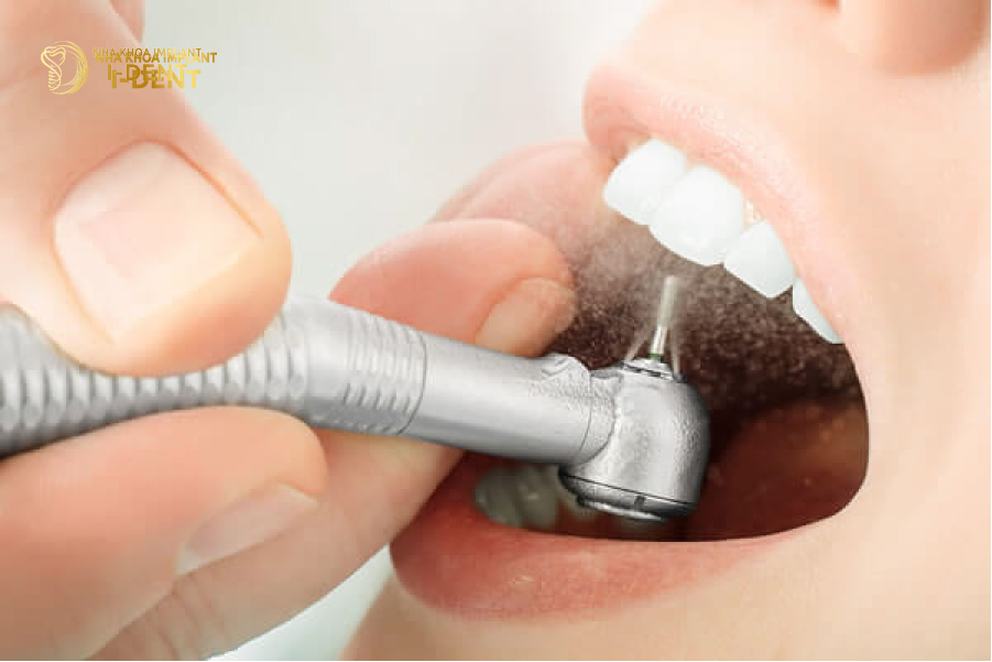 Bác sĩ mài nhỏ thân răng sứ để tháo ra dễ dàng hơn tháo răng sứ làm lại