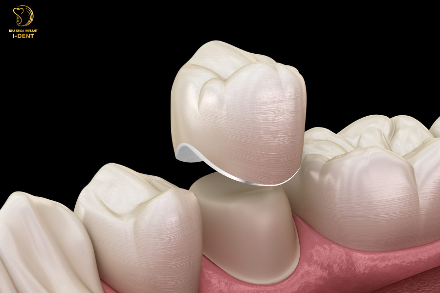răng sứ titan bao nhiêu tiền - Bọc răng sứ răng sứ titan bao nhiêu tiền - Bọc răng sứ