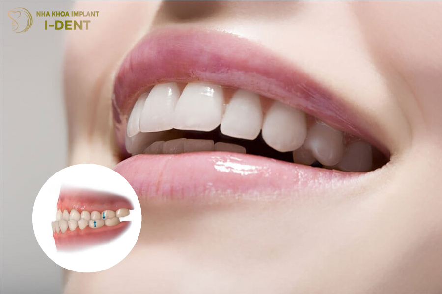 Bọc răng sứ cải thiện được tình trạng hô móm Bọc răng sứ cải thiện được tình trạng hô móm