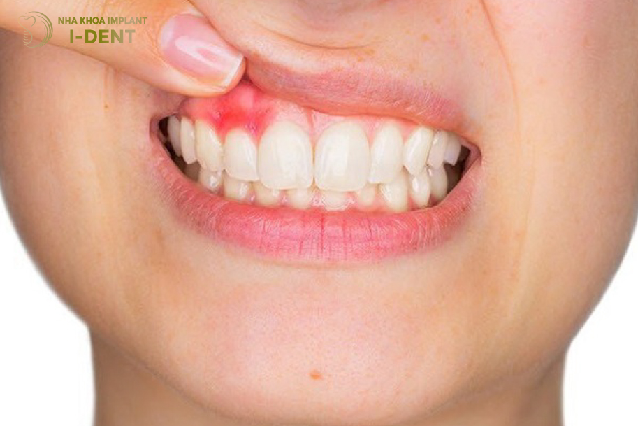 Bọc răng sứ sai cách sẽ dẫn đến răng bị viêm lợi, viêm tủy Bọc răng sứ sai cách sẽ dẫn đến răng bị viêm lợi, viêm tủy
