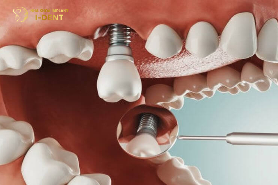 Răng Implant thay thế hoàn hảo cho chân răng đã mất răng cấm có trồng được không
