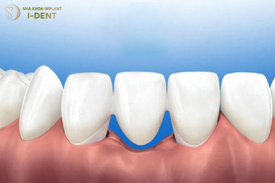 Cầu răng sứ bị hở do tiêu xương Cầu răng sứ bị hở do tiêu xương