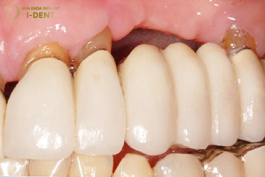 Cầu răng sứ cho 3 răng mất liền kề Cầu răng sứ cho 3 răng mất liền kề
