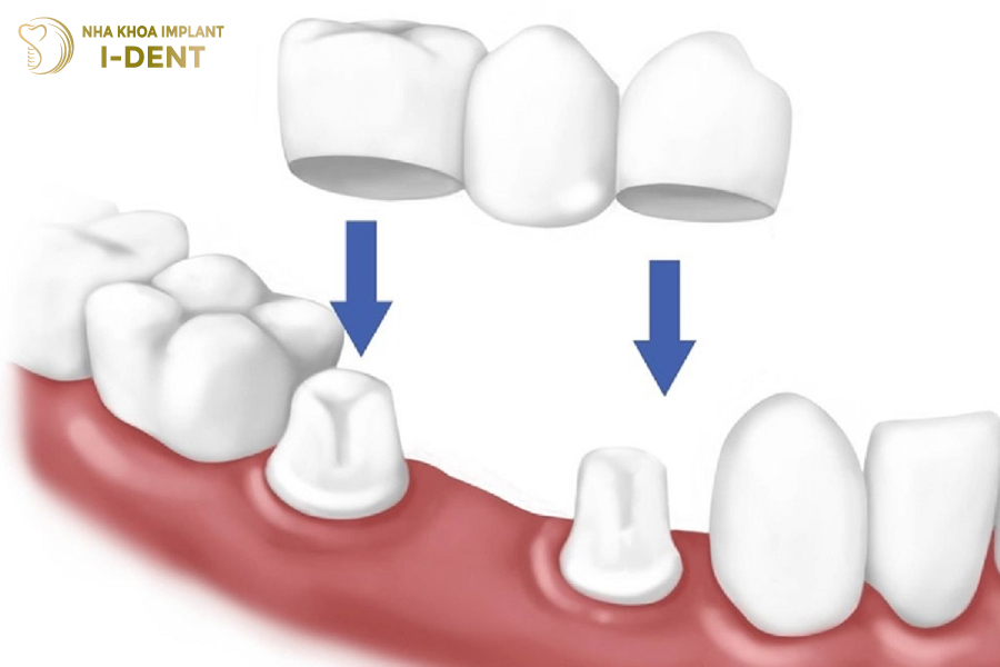 Cầu răng sứ truyền thống