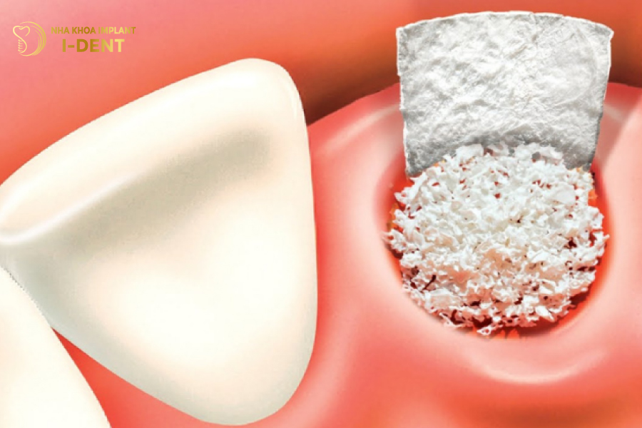 Cấy Implant xương gò má giúp hạn chế ghép xương Cấy Implant xương gò má giúp hạn chế ghép xương