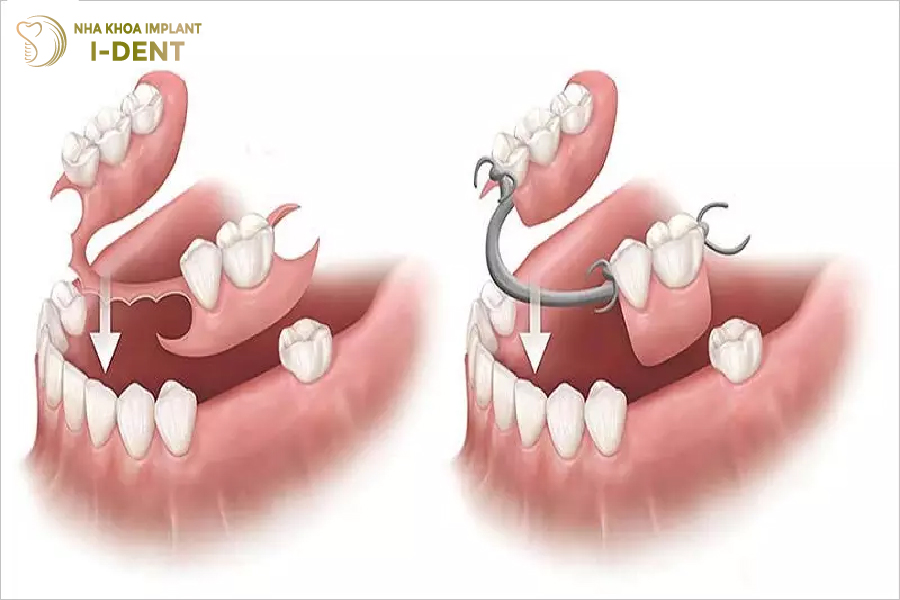 Hàm giả tháo lắp Hàm giả tháo lắp