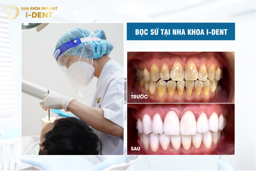 Hàm răng mọc lệch và nhiễm màu kháng sinh của chị Quỳnh Hoa Hàm răng mọc lệch và nhiễm màu kháng sinh của chị Quỳnh Hoa