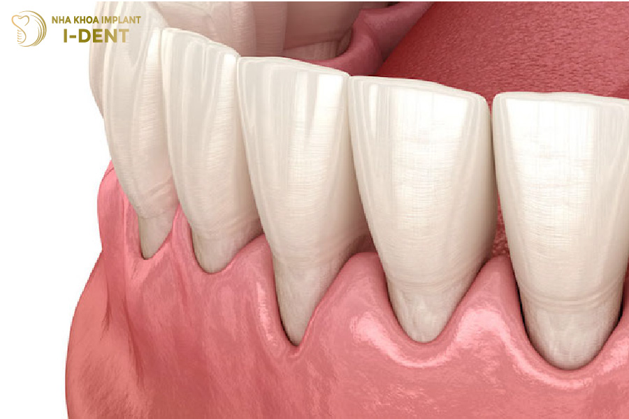 Làm răng sứ bị tụt lợi
