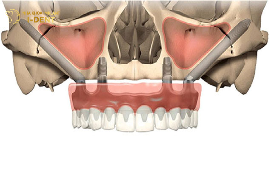 Hình dáng trụ Implant dùng để cấy xương gò má zygoma implant Hình dáng trụ Implant dùng để cấy xương gò má zygoma implant