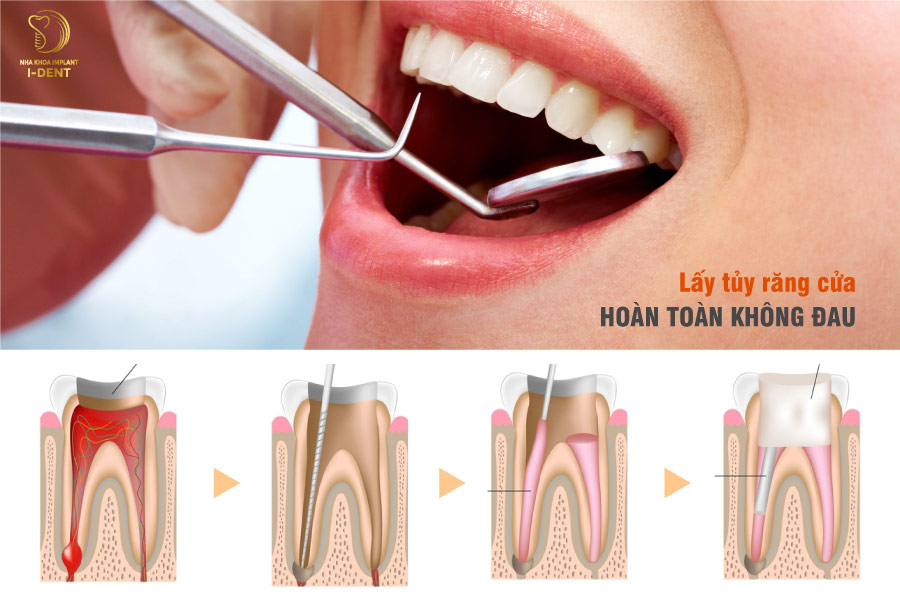 Lấy tủy răng cửa hoàn toàn không đau Lấy tủy răng cửa hoàn toàn không đau
