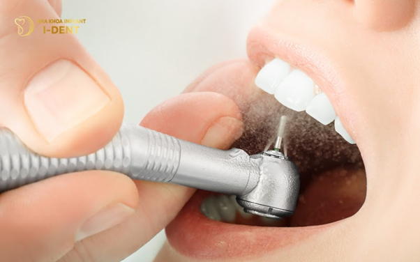 Hình ảnh cầu răng sứ hình ảnh làm cầu răng sứ