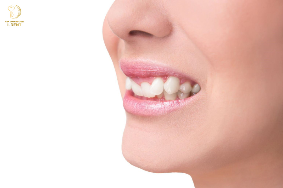 Một số trường hợp răng khểnh mọc lệch lạc, gây khó khăn trong việc ăn uống và vệ sinh Một số trường hợp răng khểnh mọc lệch lạc, gây khó khăn trong việc ăn uống và vệ sinh