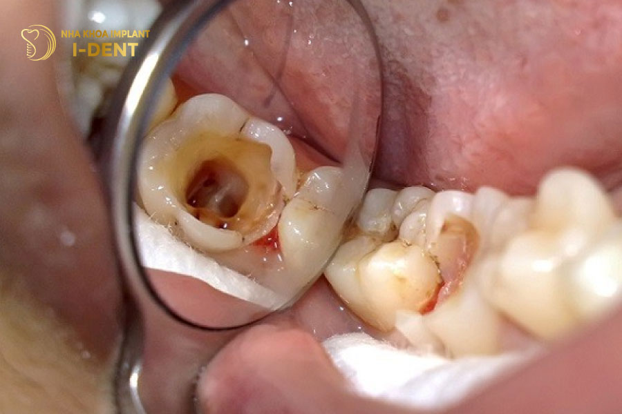 Sâu răng không được điều trị dẫn đến chết tủy Tình trạng răng chết tủy