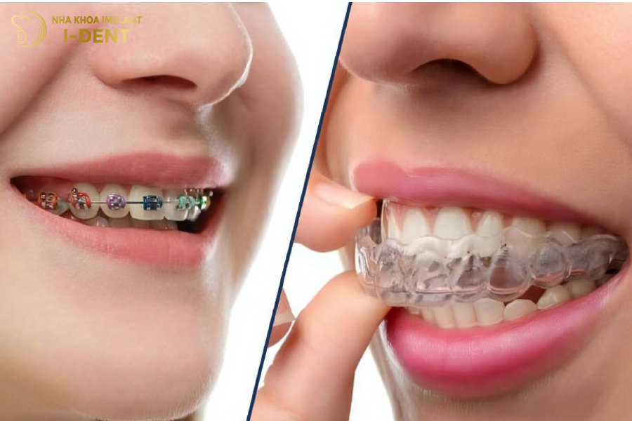niềng răng hay bọc sứ tốt hơn