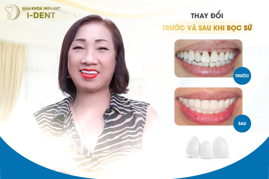 khách hàng sau khi bọc răng sứ tại Nha khoa I-DENT khách hàng sau khi bọc răng sứ tại Nha khoa I-DENT