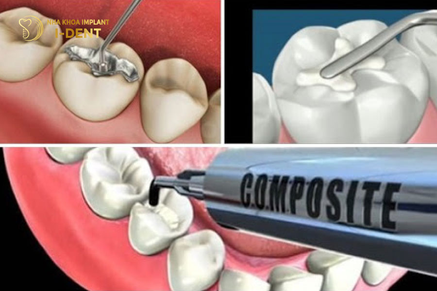 Những yếu tố trám răng giữ được lâu Những yếu tố trám răng giữ được lâu