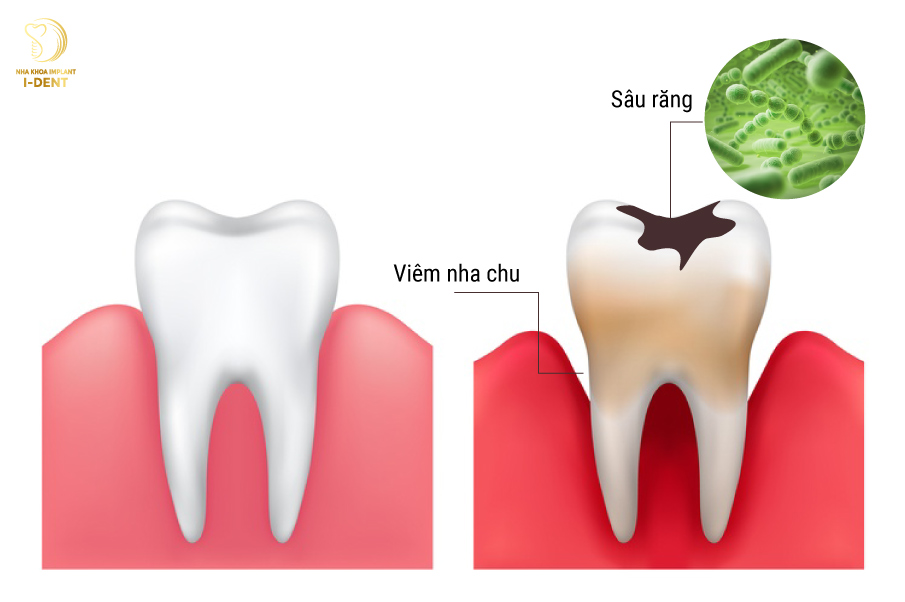 Phụ thuộc vào mức độ sâu răng