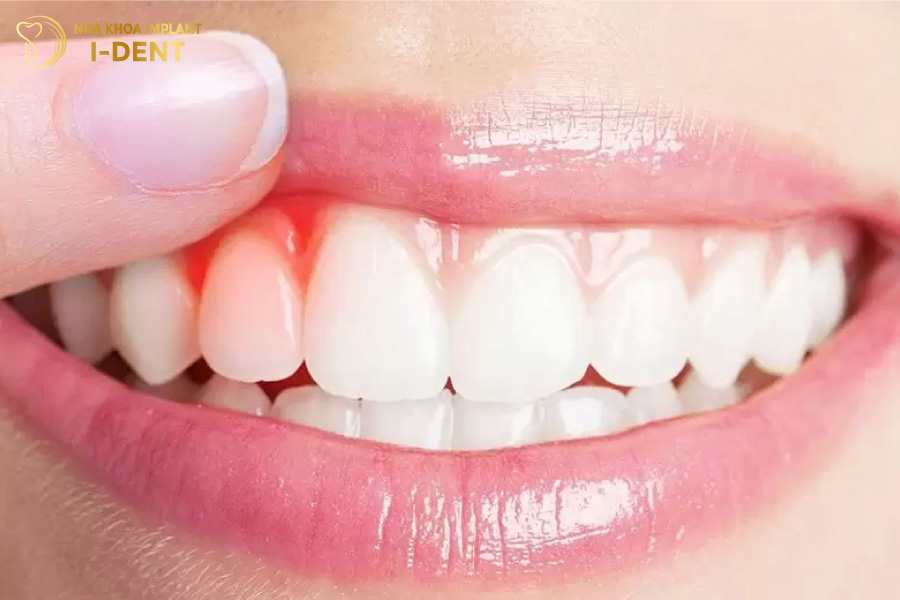 răng bọc sứ lâu năm bị đau