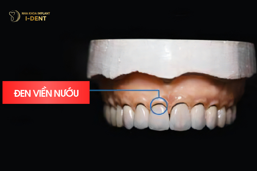 Răng sứ Ceramco gây đen viền nướu