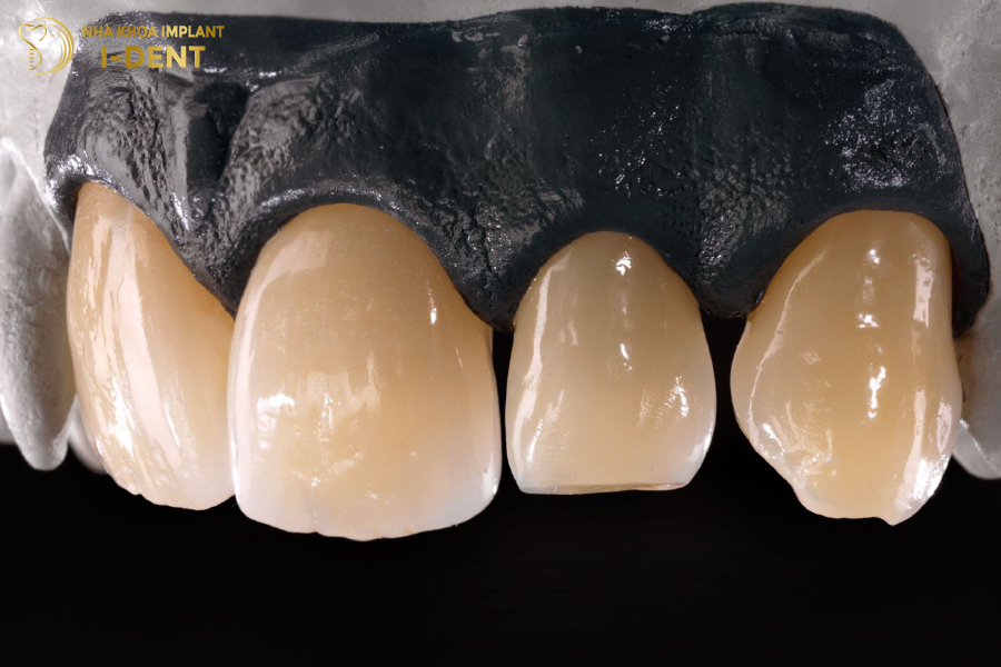 Răng sứ Ceramill bền đẹp và khả năng ăn nhai như răng thật Răng sứ Ceramill bền đẹp và khả năng ăn nhai như răng thật