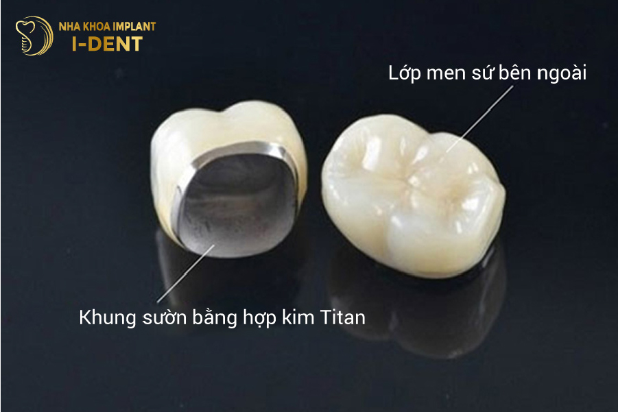 Cấu tạo của răng sứ Titan có chứa thành phần kim loại Cấu tạo của răng sứ Titan có chứa thành phần kim loại