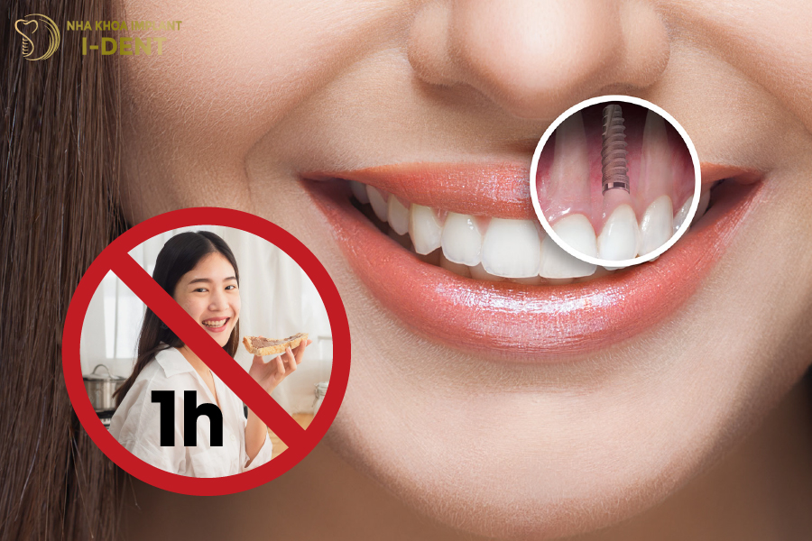 Sau khi cắm trụ Implant, không nên ăn trong 1 giờ đầu tiên Sau khi cắm trụ Implant, không nên ăn trong 1 giờ đầu tiên
