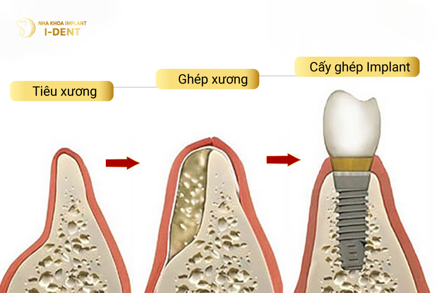 ghép xương