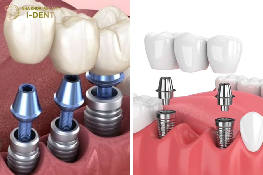 Trồng Implant cho 3 răng mất liên tiếp Trồng Implant cho 3 răng mất liên tiếp