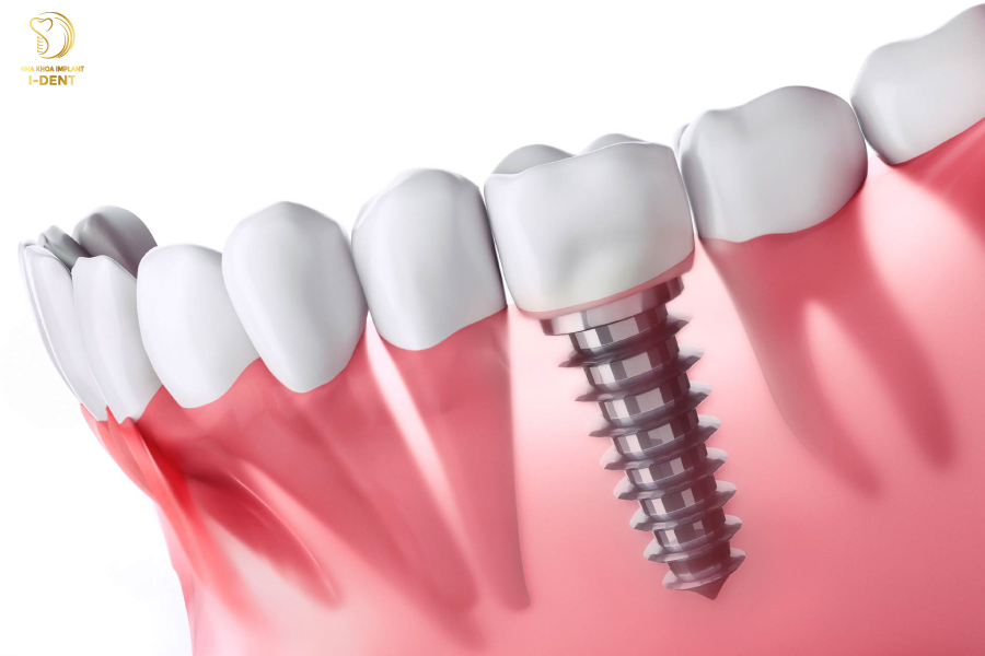 Trồng răng sứ không có chân răng bằng phương án cấy ghép Implant Trồng răng sứ không có chân răng bằng phương án cấy ghép Implant