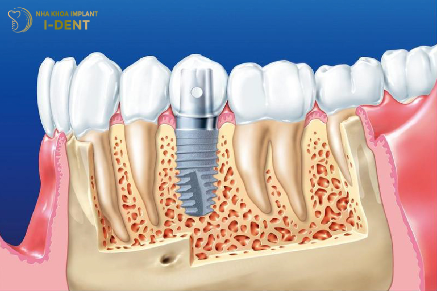 Trụ Implant thay thế cho chân răng thật và ngăn chặn tiêu xương Trụ Implant thay thế cho chân răng thật và ngăn chặn tiêu xương