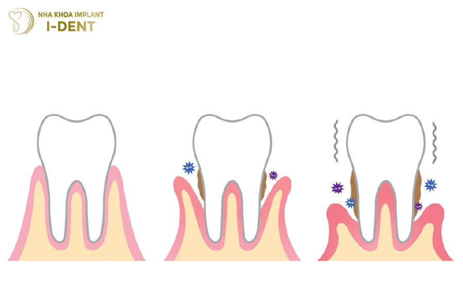Răng sứ bị tụt lợi