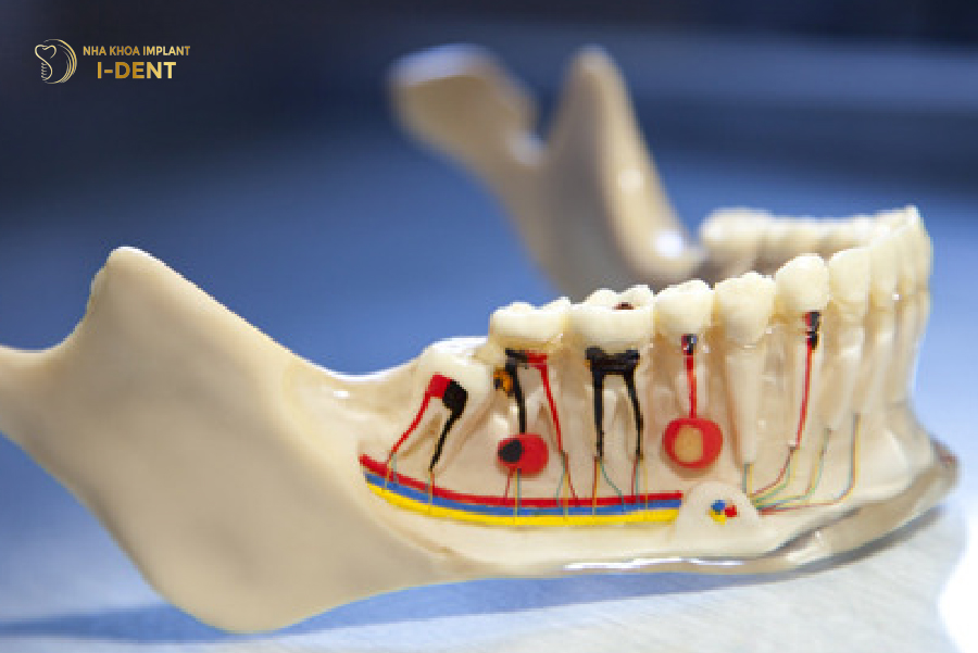 Viêm tủy gây đau nhức và buộc phải tháo răng sứ ra để điều trị Viêm tủy gây đau nhức và buộc phải tháo răng sứ ra để điều trị