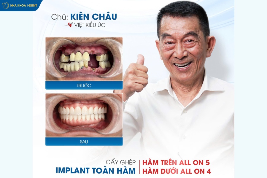 trồng răng implant cho người già