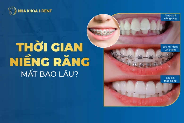 niềng răng mất bao lâu
