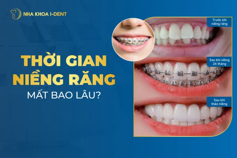 niềng răng mất bao lâu