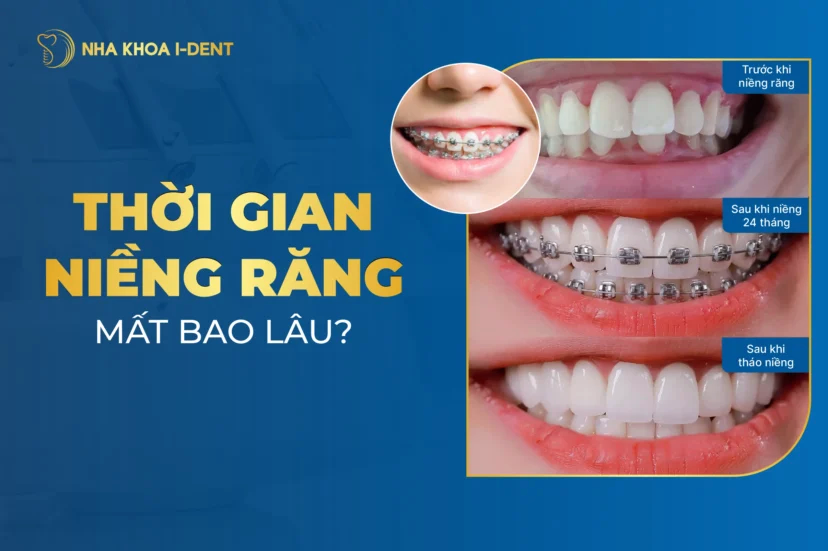 niềng răng mất bao lâu